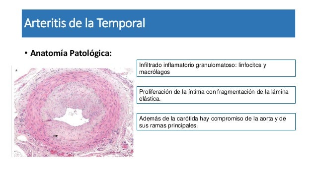 arteritis temporal de celulas gigantes